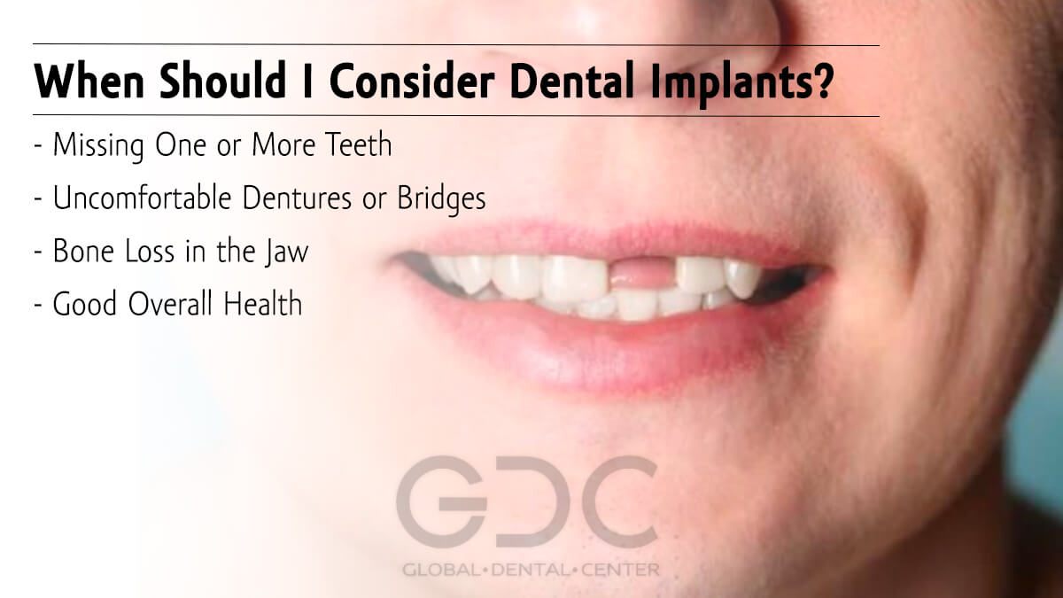 When Should I Consider Dental Implants?