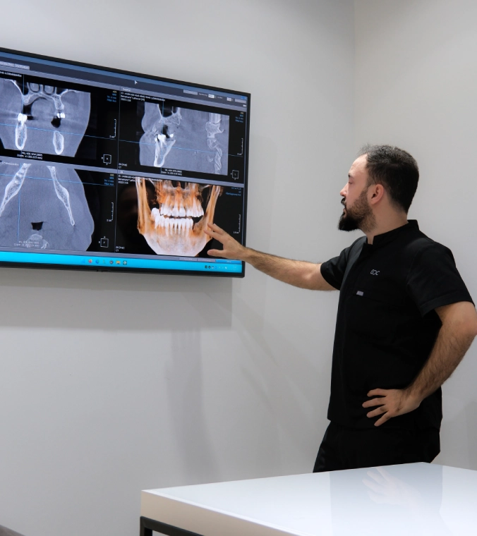 All on 4 Implants Turkey