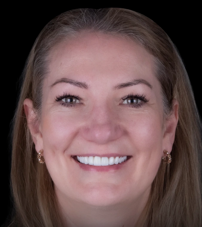 Dental Crowns Antalya